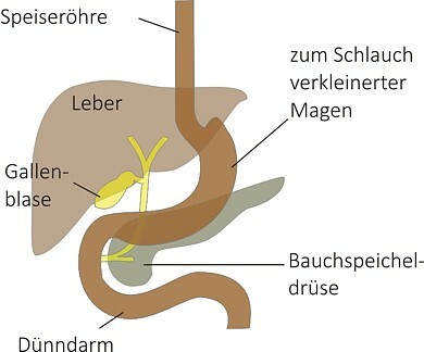 schlauchmagen