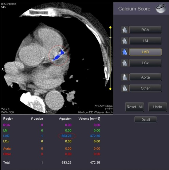 Calcium-Score